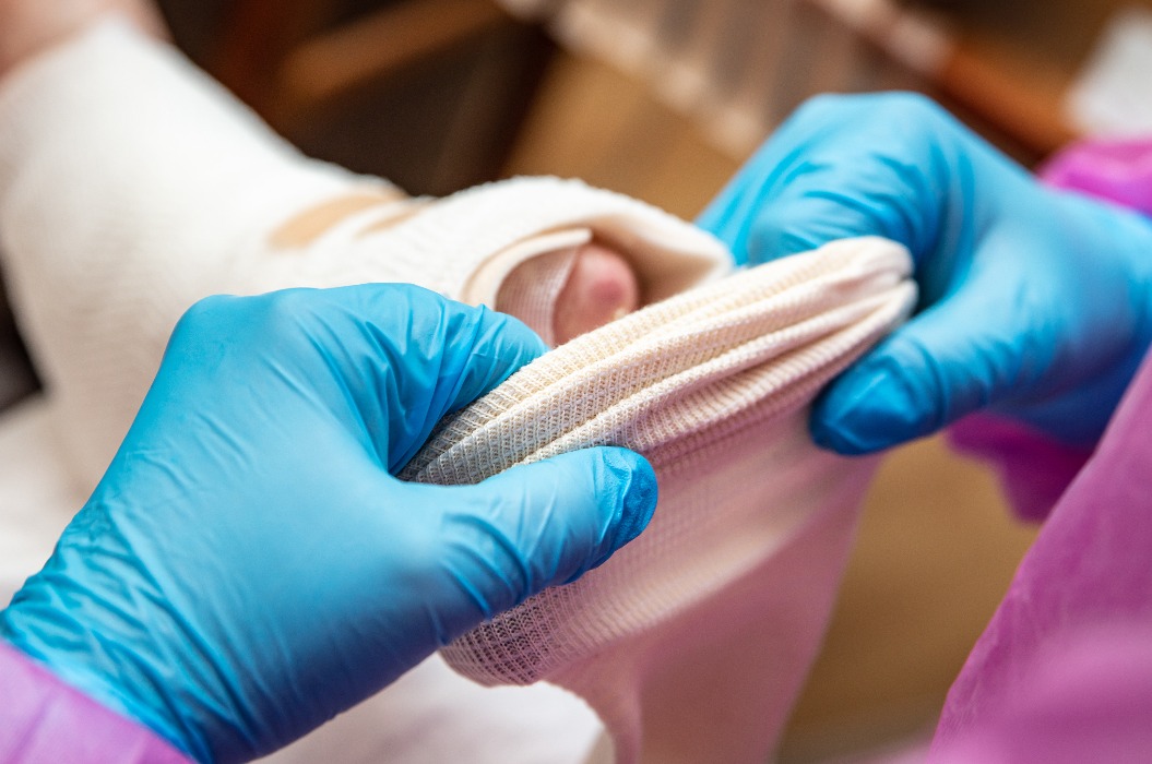 Epidermolysis bullosa, Krankenschwester verbindet den Fuß